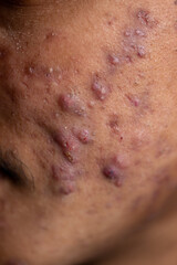 Fototapeta premium Backgrounds of lesions skin caused by acne on the face in the clinic. 