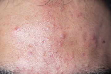 Fototapeta premium Backgrounds of lesions skin caused by acne on the face in the clinic. 