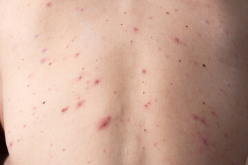 closeup a man back who having varicella blister or chickenpox