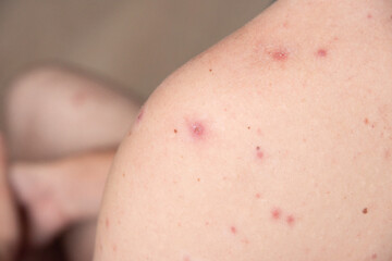 closeup a man back who having varicella blister or chickenpox