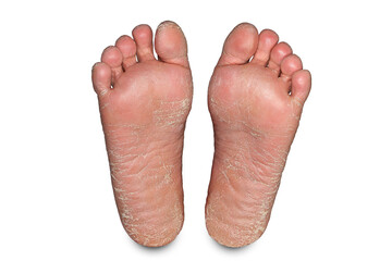 Skin problems of the feet, dry heels on a white background