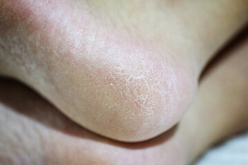 Disease of the feet. Cracked and dry heel of foot skin.