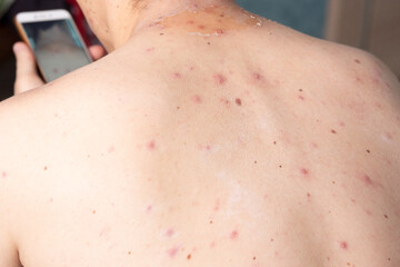 closeup a man back who having varicella blister or chickenpox