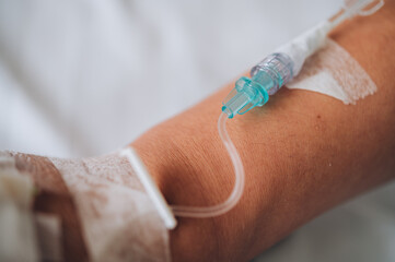 Patient's hand with Total Parenteral Nutrition (TPN) being administered into vein