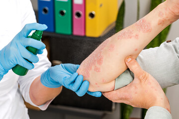 Dermatologist wearing gloves to apply medicine to the skin of a sick patient. Examination and diagnosis of skin diseases-allergies, psoriasis, eczema, dermatitis