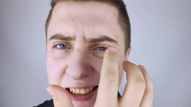 A man stands in front of a mirror and sees inflammation of the upper eyelid. Redness of the skin around the eyes and blepharitis.