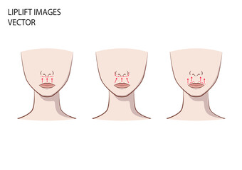 人中短縮・リップリフトイメージ図（鼻の下を短くする美容整形）