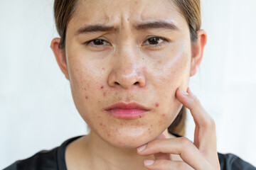 Obraz premium Worried woman having problems of acne inflamed on her face. Inflamed acne consists of swelling, redness, and pores that are deeply clogged with bacteria, oil, and dead skin cells.