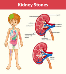 Kidney stones symptoms cartoon style infographic