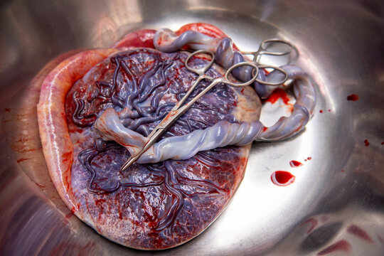  placenta with umbilical cord is in a silver saline bowl after a birth