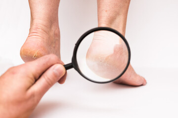 Highly dry heels woman on a white background closeup through a magnifying glass