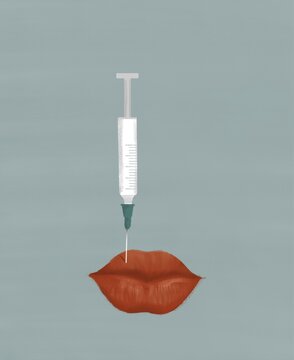 Lip augmentation with Botox.