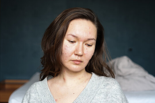 An adult woman infected with varicella virus at home