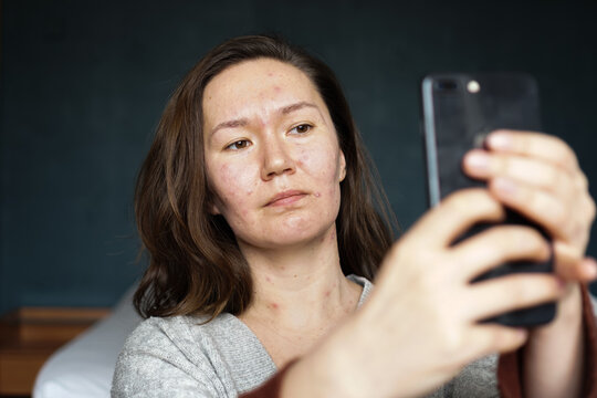 An adult woman infected with varicella virus taking a selfie at home