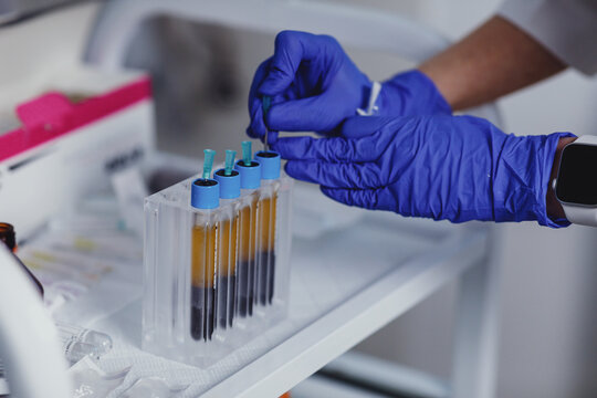 Test of erythrocyte sedimentation rate