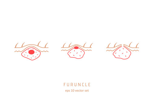 Abscess - vector icons set.