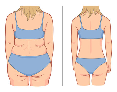 Woman's back before and after weight loss. Vector illustration.