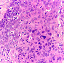 Photo of cervix shows dysplasia and atypical mitosis, magnification 400x, photo under microscope