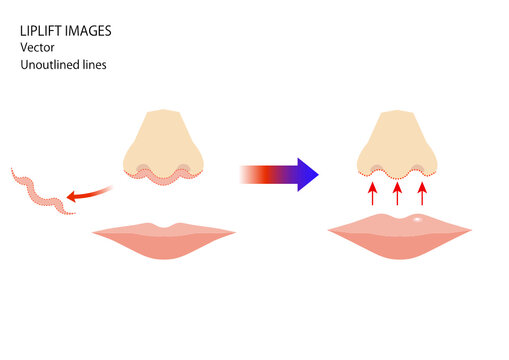 人中短縮（LIPLIFT）リップリフト、鼻下短縮　整形手術イメージイラスト