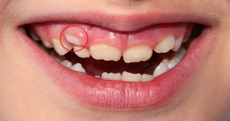 Children's teeth. The molar grows in the second row. Anomalies of tooth growth.