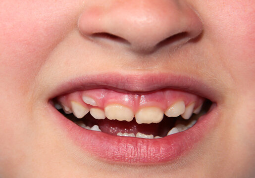 Children's teeth. The molar grows in the second row. Anomalies of tooth growth.
