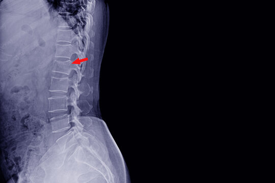 x-ray lumbar spine fracture L1 on red point.