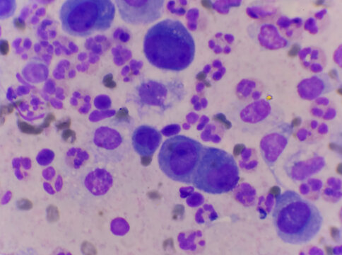 Mesothelial cells in body fluid sample.