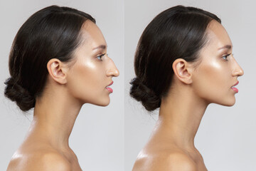 Comparison of the female nose after plastic surgery. Before after. Rhinoplasty