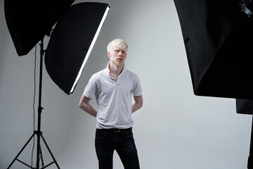 albinism albino man in studio dressed t-shirt isolated on a white background. abnormal deviations....