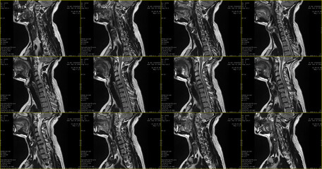 set of sagittal MRI scans of neck area of caucasian 34 years old male with bilateral paramedial...