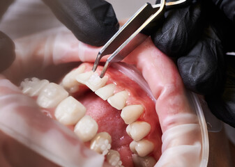 Close up of orthodontist hand in black glove putting braces on young woman teeth. Patient with...