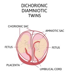 Anatomy of abdomen with twins. Twin types infographic elements in flat design. Monozygotic or Dizygotic Placentation of twins medical illustration and icons isolated on white background