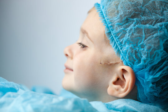 Profile of a little boy with surgical suture on the face near the ear. Selective focus.