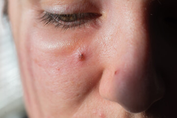 Acne on a woman's face close up. Portrait of a woman with problem skin