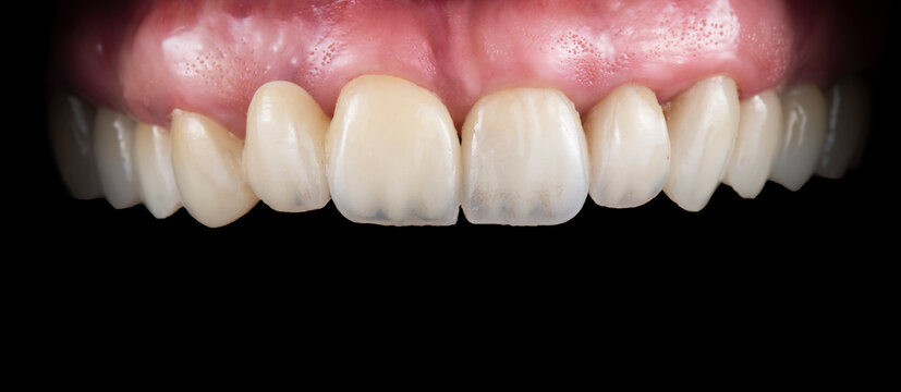 picture of full mought reconstraction by crowns implants and veneers