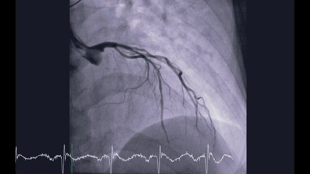 Coronary angiography is a test used to find out how much narrowing there is in coronary arteries for detect cardiac arrest ,Showing left coronary artery.