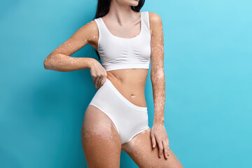 Fototapeta premium Cropped shot of fit faceless woman has perfect figure special skin with white patches dressed bra and panties poses against blue background.