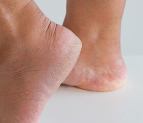 Fototapeta premium Close up the deep crack dry heel of woman foot with bad skin is covered with cracks