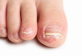 Front angle shot of a finger of a child with fungal nail infection against white background.