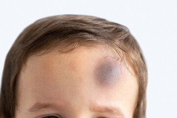 Close-up of a boy with injury on head