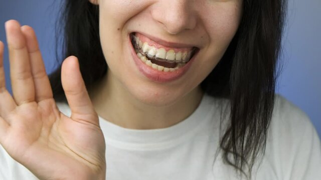 Woman easily inserts and removes invisible transparent aligner from the upper jaw