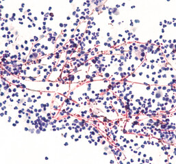 Yeast Infection; Budding yeast and pseudohyphae of Candida albicans identified in a urine cytology specimen.  Pap stain.  