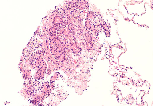 Photomicrograph of prostatic adenocarcinoma (prostate cancer) metastatic to lung.  