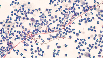 Yeast Infection; Budding yeast and pseudohyphae of Candida albicans identified in a urine cytology specimen.  Pap stain.  