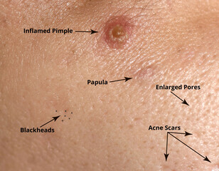 Types of acne and acne on the skin. Enlarged pores, Inflamed pimple, Blackheads, Acne scars, Papule