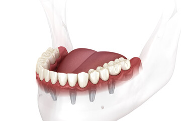 Removable mandibular prosthesis all on 6 system supported by implants. Medically accurate 3D illustration of human teeth and dentures