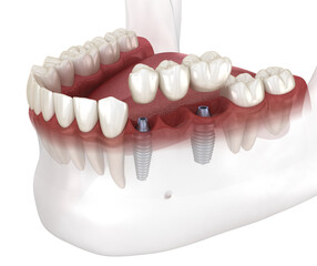 Dental bridge and crown placement over implants. Dental 3D animation concept