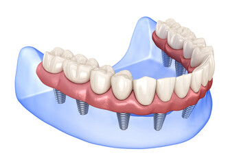Maxillary and Mandibular prosthesis with gum All on 8 system supported by implants. Medically accurate 3D illustration of human teeth and dentures