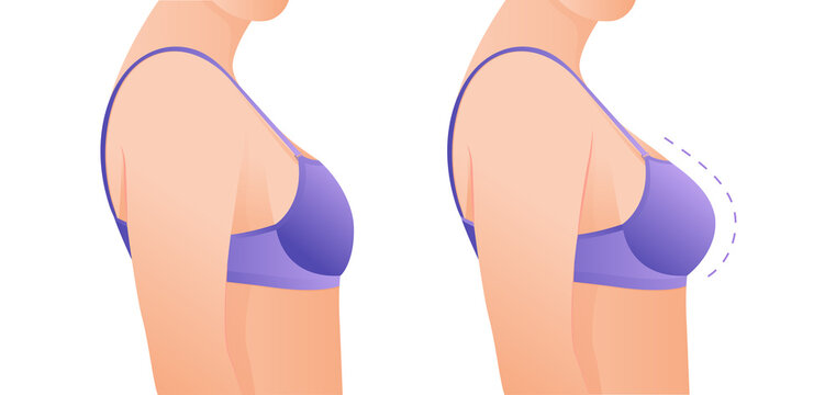 Female breasts in bra before and after augmentation/ breast size correction. Plastic surgery concept.woman body changing from overweight to slim as a result of training, dieting or Fitness workout.