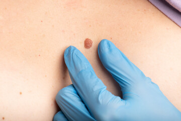 Doctor checking up the mole before removal